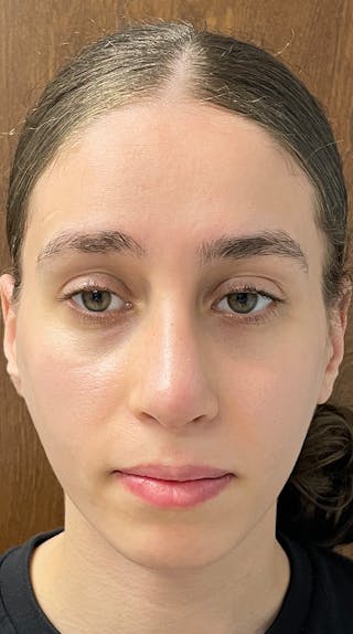 Rhinoplasty Before & After Gallery - Patient 122833306 - Image 2