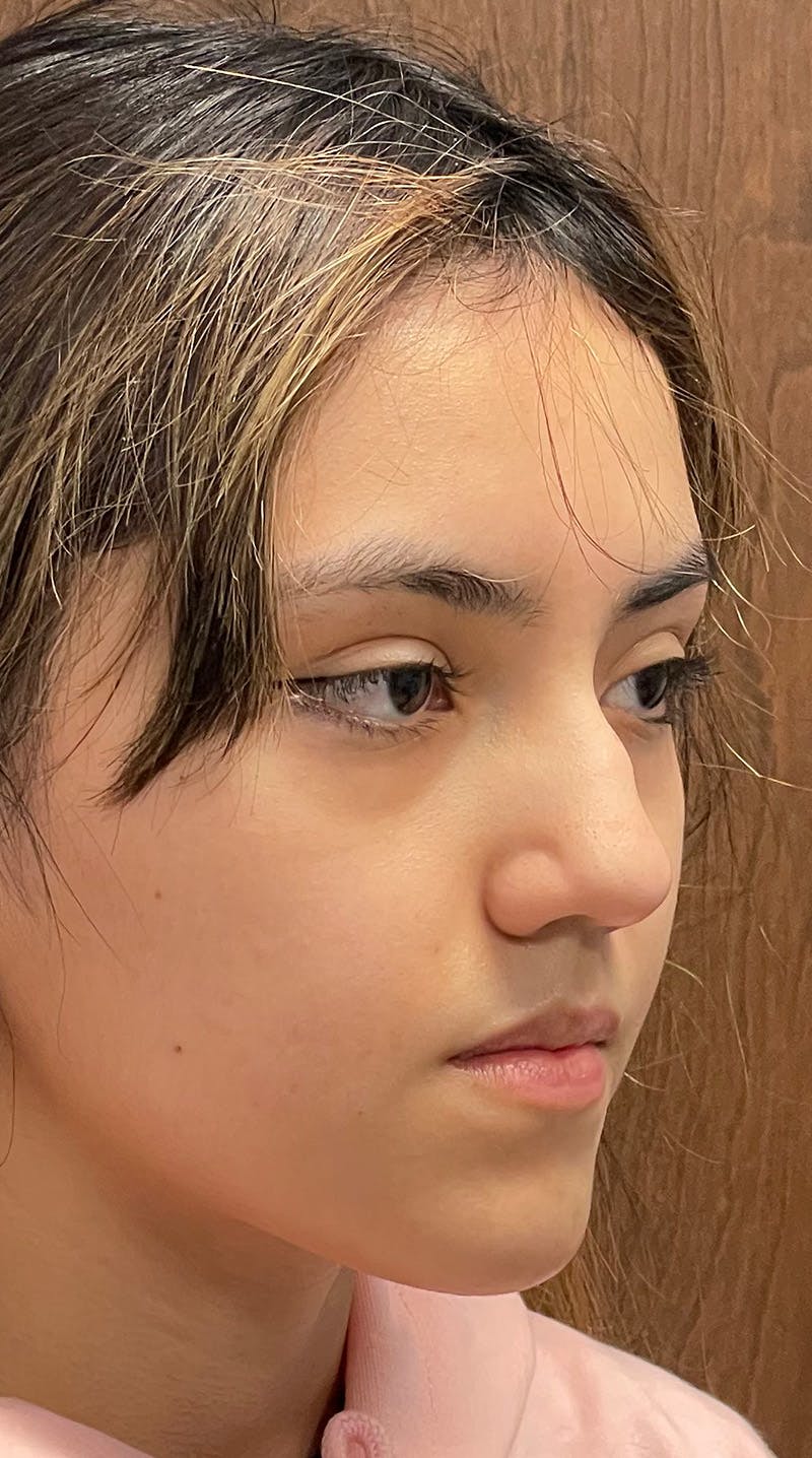 Rhinoplasty Before & After Gallery - Patient 122833308 - Image 7