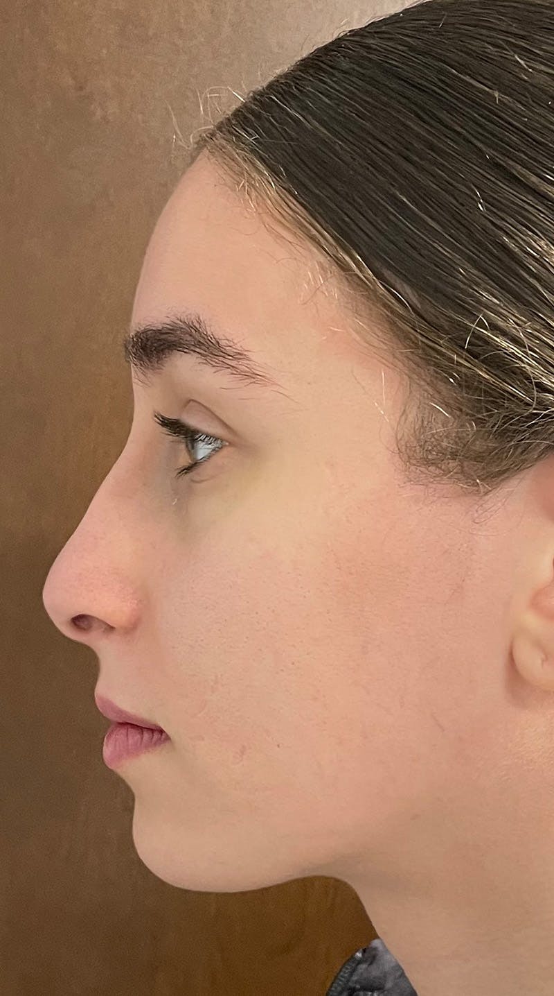 Rhinoplasty Before & After Gallery - Patient 122833306 - Image 5