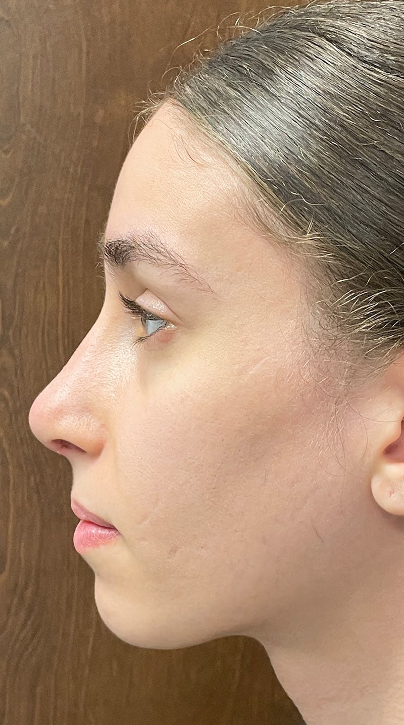 Rhinoplasty Before & After Gallery - Patient 122833306 - Image 6