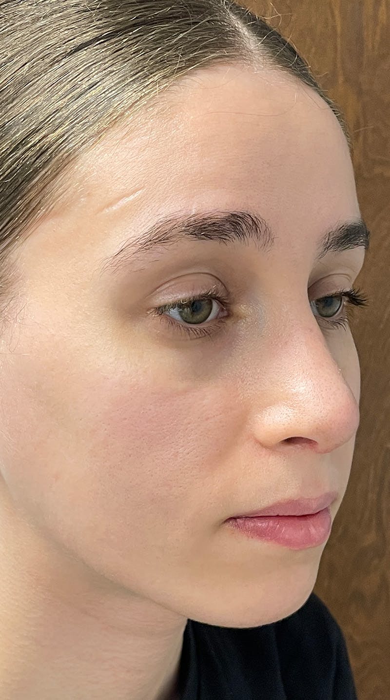 Rhinoplasty Before & After Gallery - Patient 122833306 - Image 8