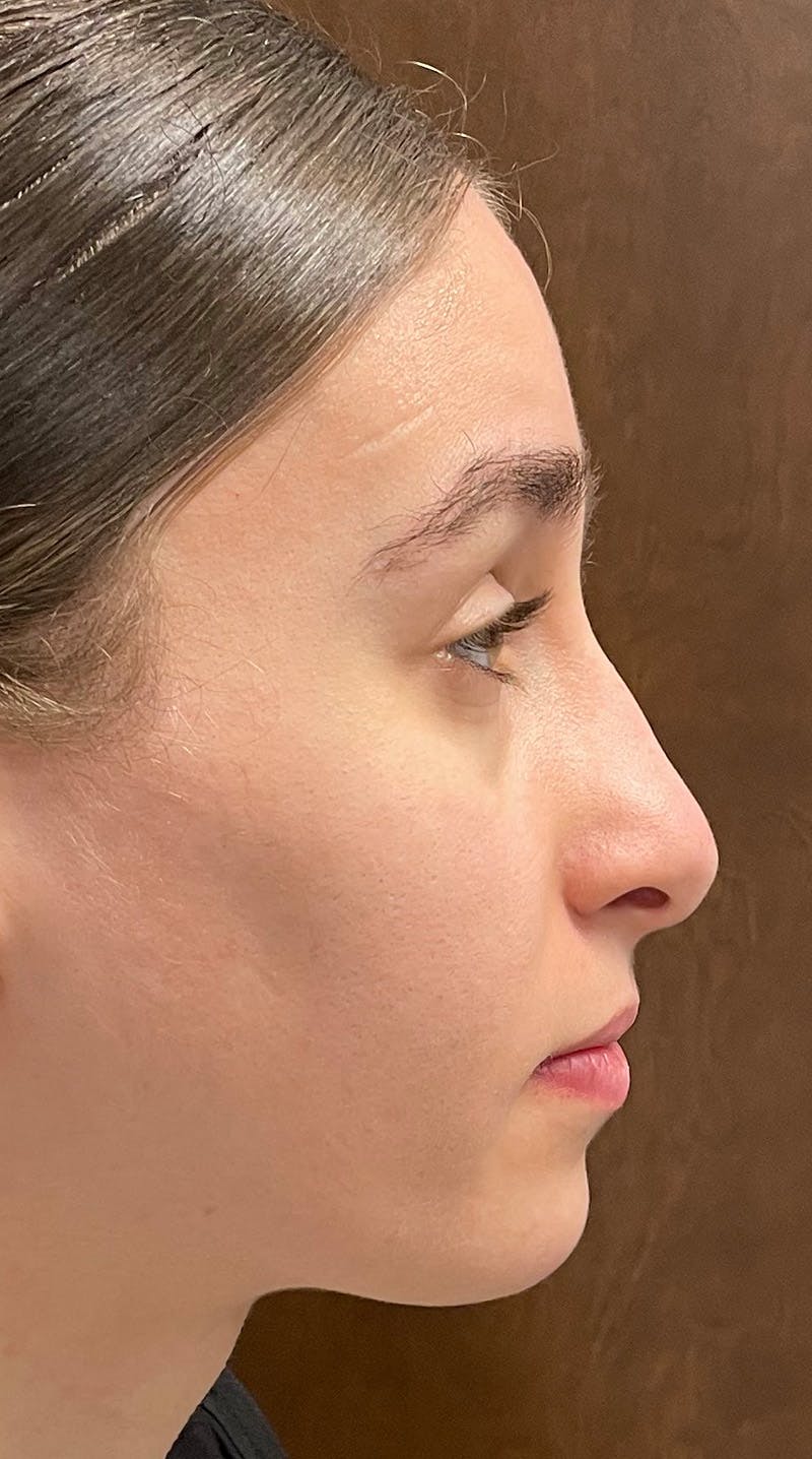 Rhinoplasty Before & After Gallery - Patient 122833306 - Image 9