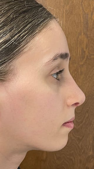 Rhinoplasty Before & After Gallery - Patient 122833306 - Image 10