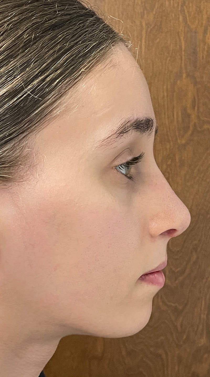 Rhinoplasty Before & After Gallery - Patient 122833306 - Image 10