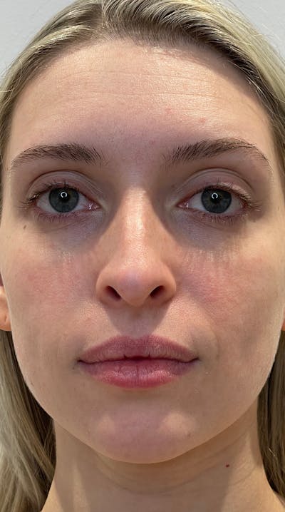 Rhinoplasty Before & After Gallery - Patient 141547529 - Image 1