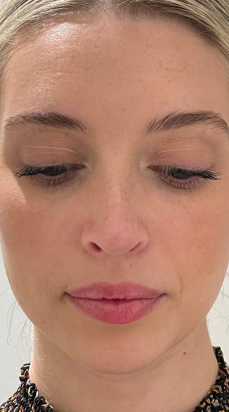 Rhinoplasty Before & After Gallery - Patient 141547529 - Image 2