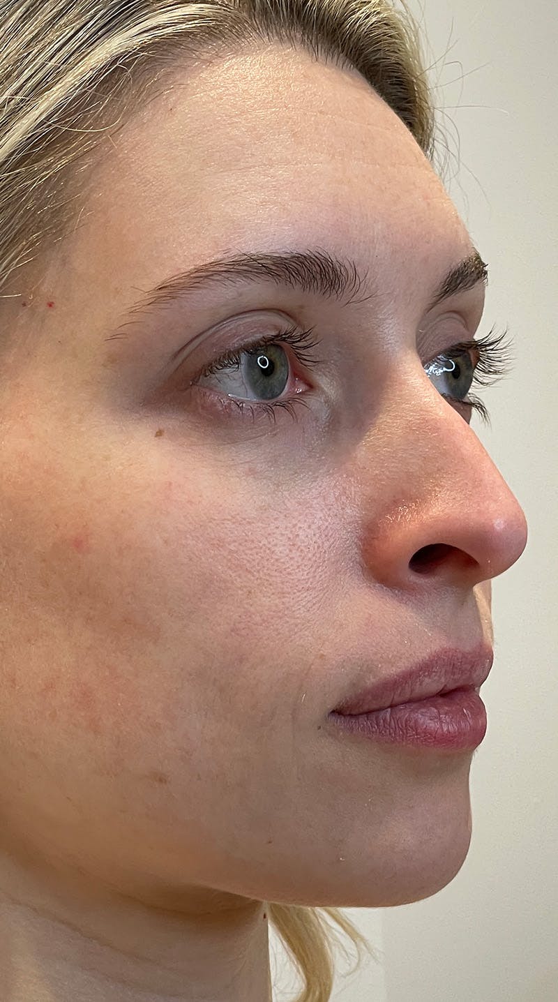 Rhinoplasty Before & After Gallery - Patient 141547529 - Image 3