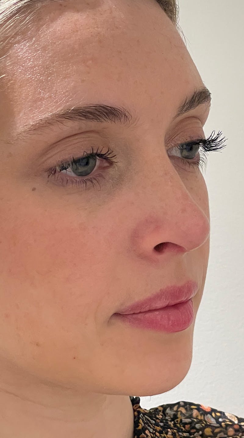 Rhinoplasty Before & After Gallery - Patient 141547529 - Image 4