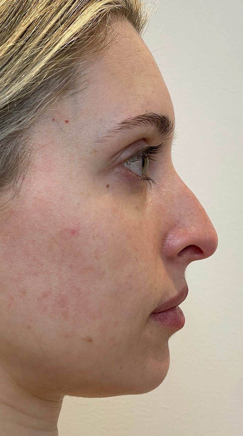 Rhinoplasty Before & After Gallery - Patient 141547529 - Image 5