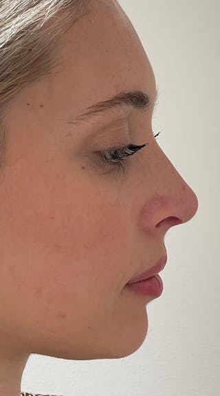 Rhinoplasty Before & After Gallery - Patient 141547529 - Image 6