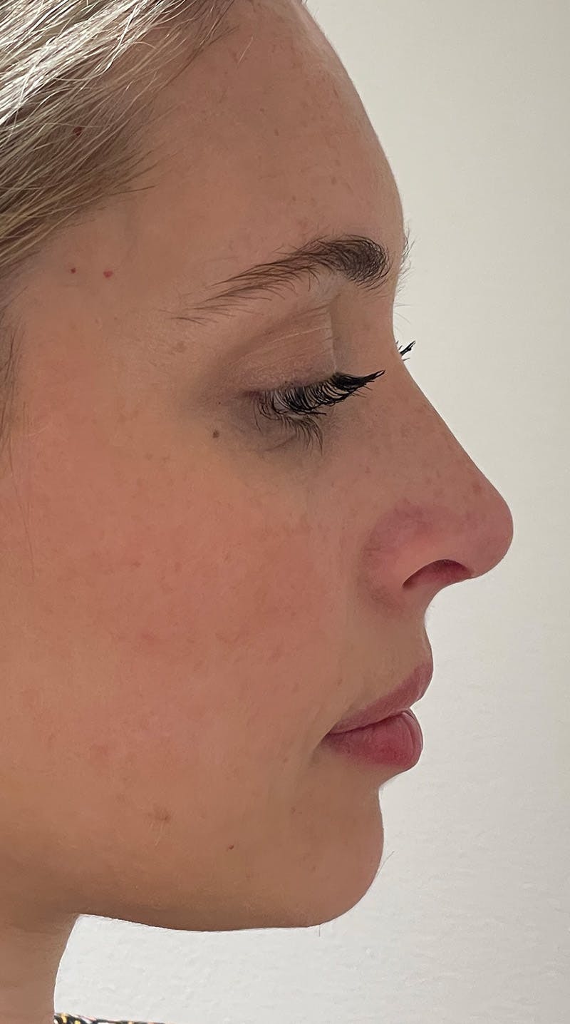 Rhinoplasty Before & After Gallery - Patient 141547529 - Image 6