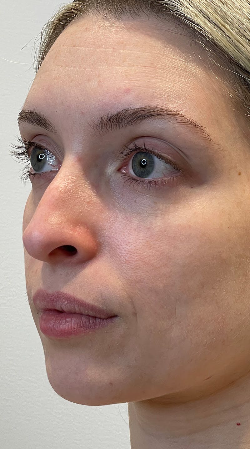 Rhinoplasty Before & After Gallery - Patient 141547529 - Image 7