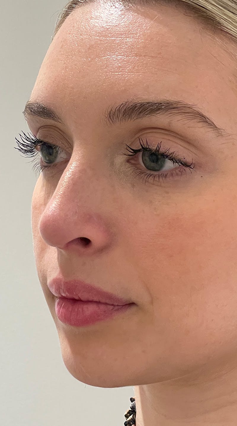 Rhinoplasty Before & After Gallery - Patient 141547529 - Image 8
