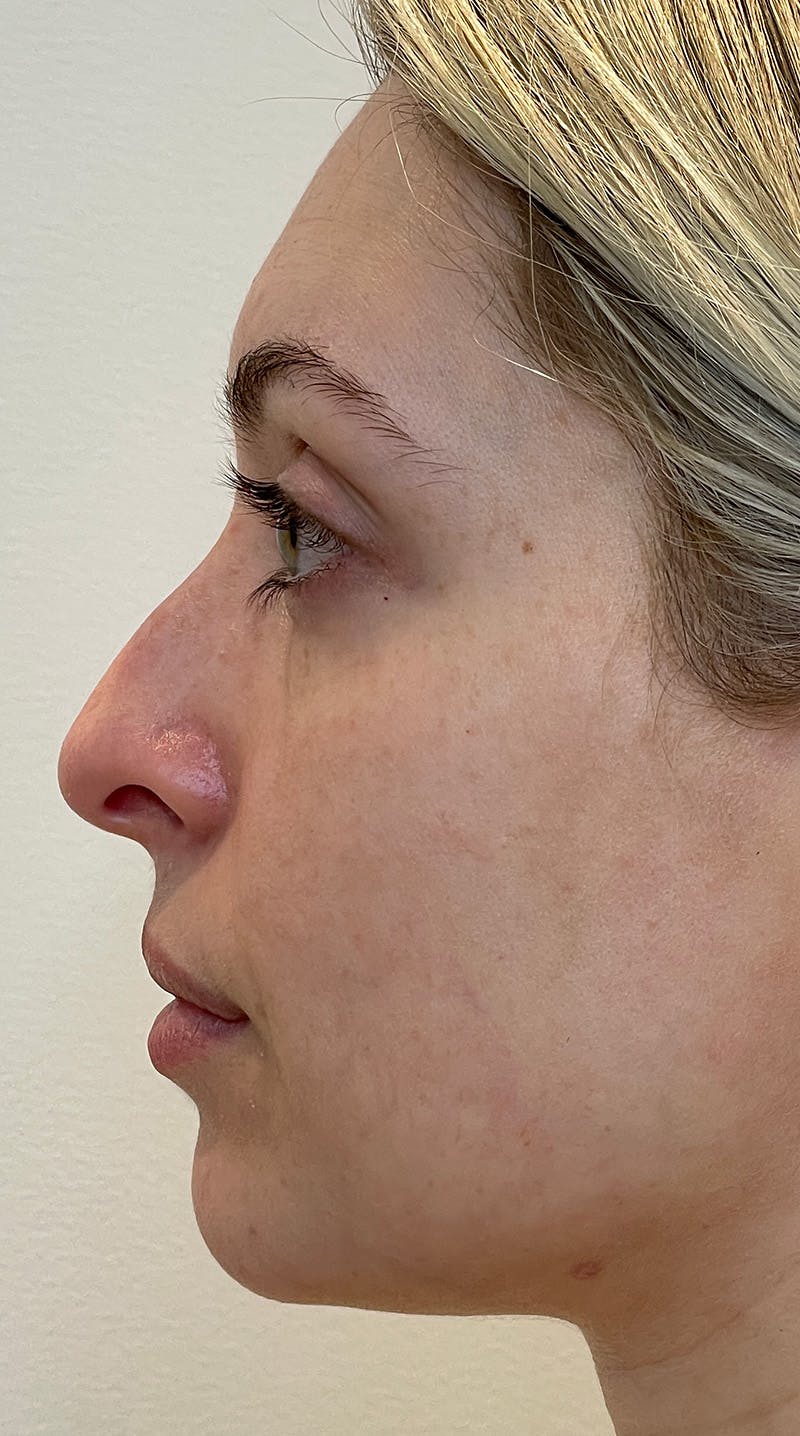 Rhinoplasty Before & After Gallery - Patient 141547529 - Image 9