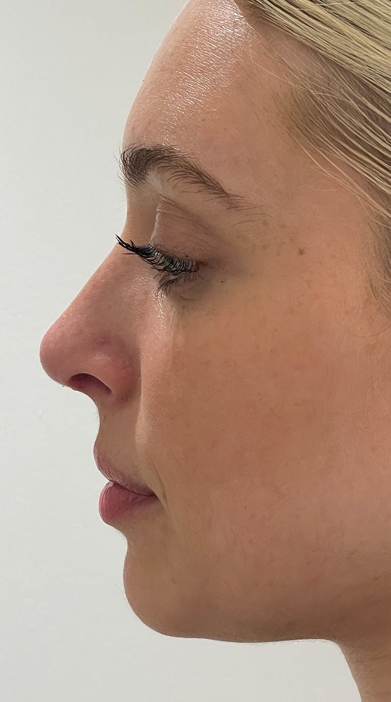 Rhinoplasty Before & After Gallery - Patient 141547529 - Image 10