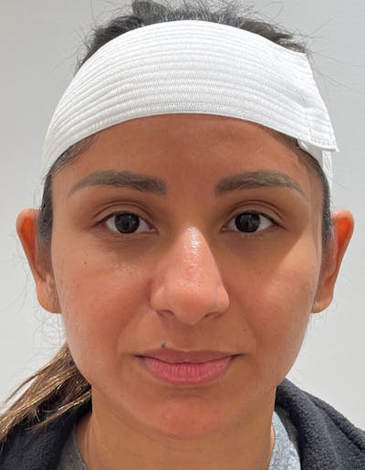 Otoplasty Before & After Gallery - Patient 141547530 - Image 1