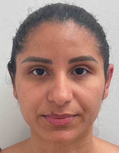 Otoplasty Before & After Gallery - Patient 141547530 - Image 2