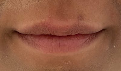 Lip Augmentation Before & After Gallery - Patient 141547534 - Image 1