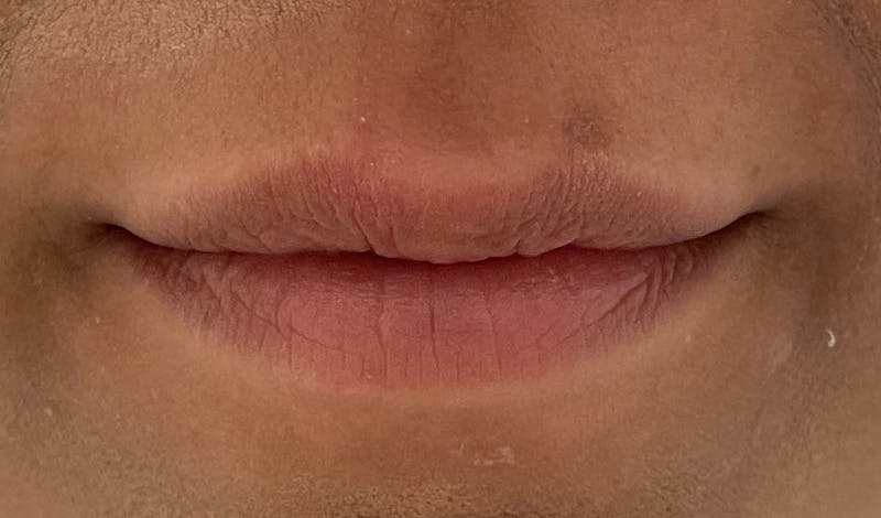 Lip Augmentation Before & After Gallery - Patient 141547534 - Image 1