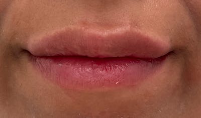 Lip Augmentation Before & After Gallery - Patient 141547534 - Image 2