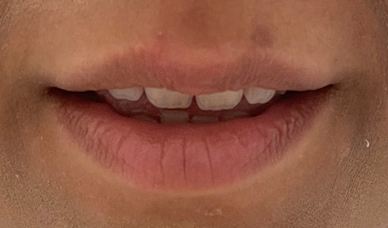 Lip Augmentation Before & After Gallery - Patient 141547534 - Image 3