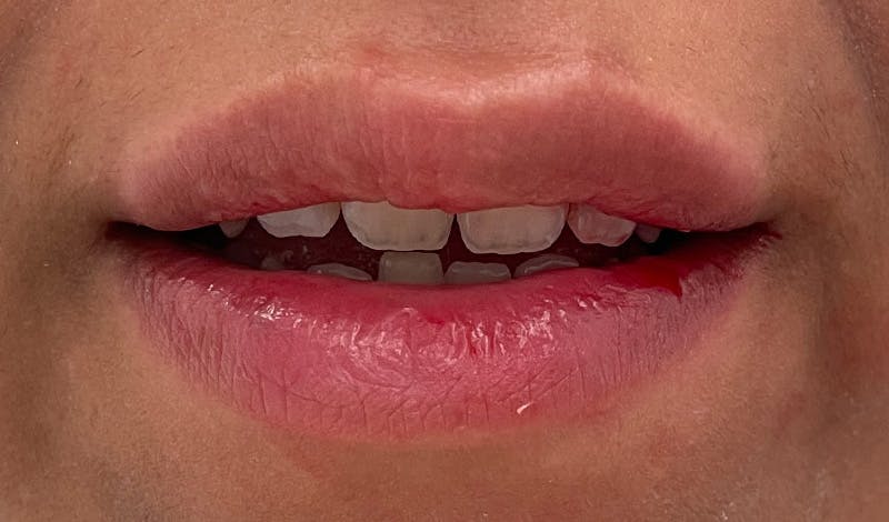 Lip Augmentation Before & After Gallery - Patient 141547534 - Image 4