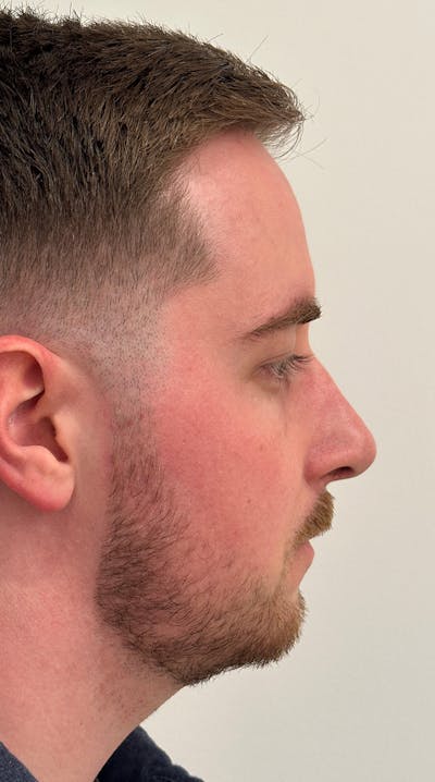 Rhinoplasty Before & After Gallery - Patient 122833307 - Image 2