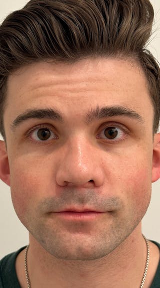 Rhinoplasty Before & After Gallery - Patient 148972634 - Image 2