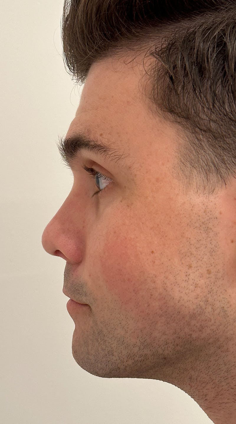 Rhinoplasty Before & After Gallery - Patient 148972634 - Image 6