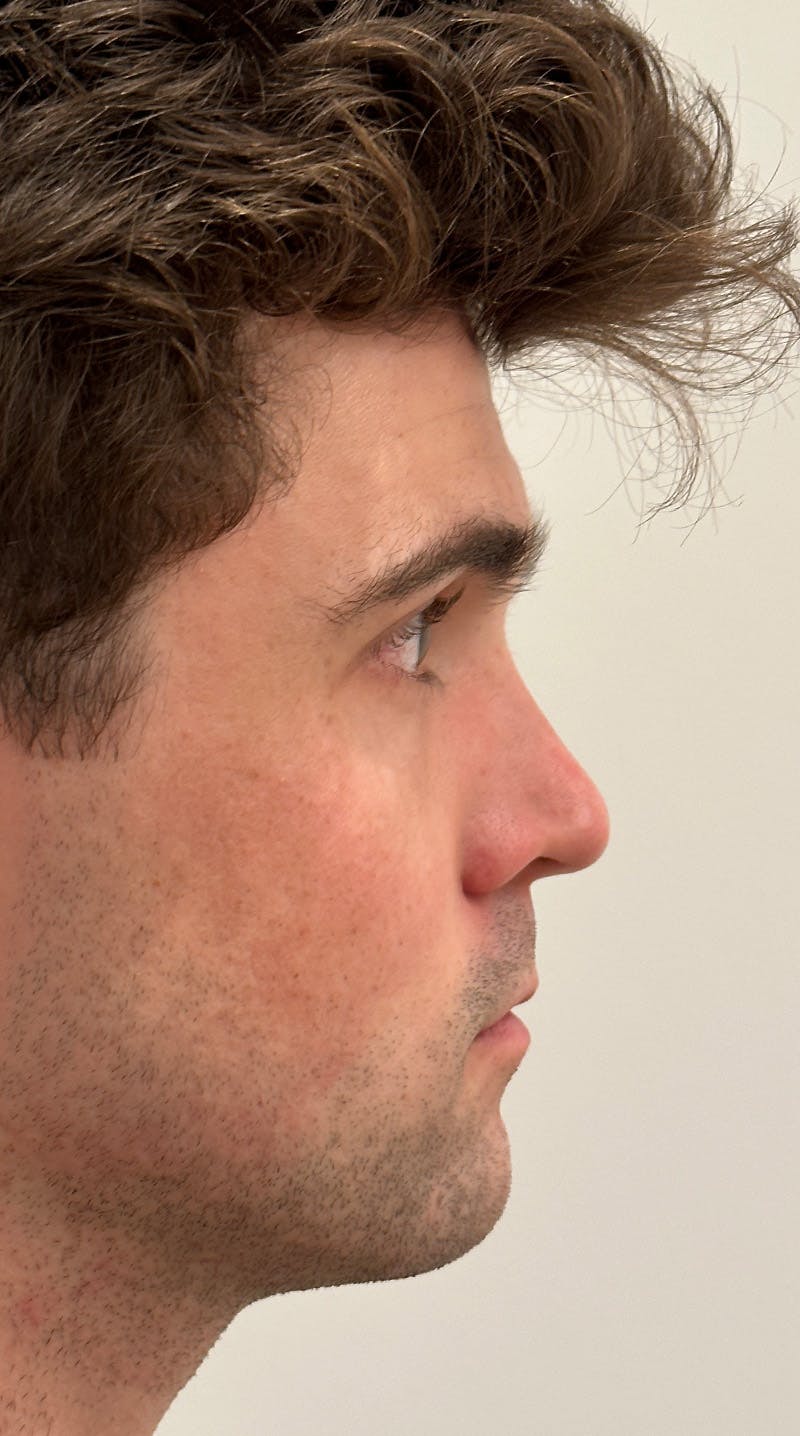 Rhinoplasty Before & After Gallery - Patient 148972634 - Image 9