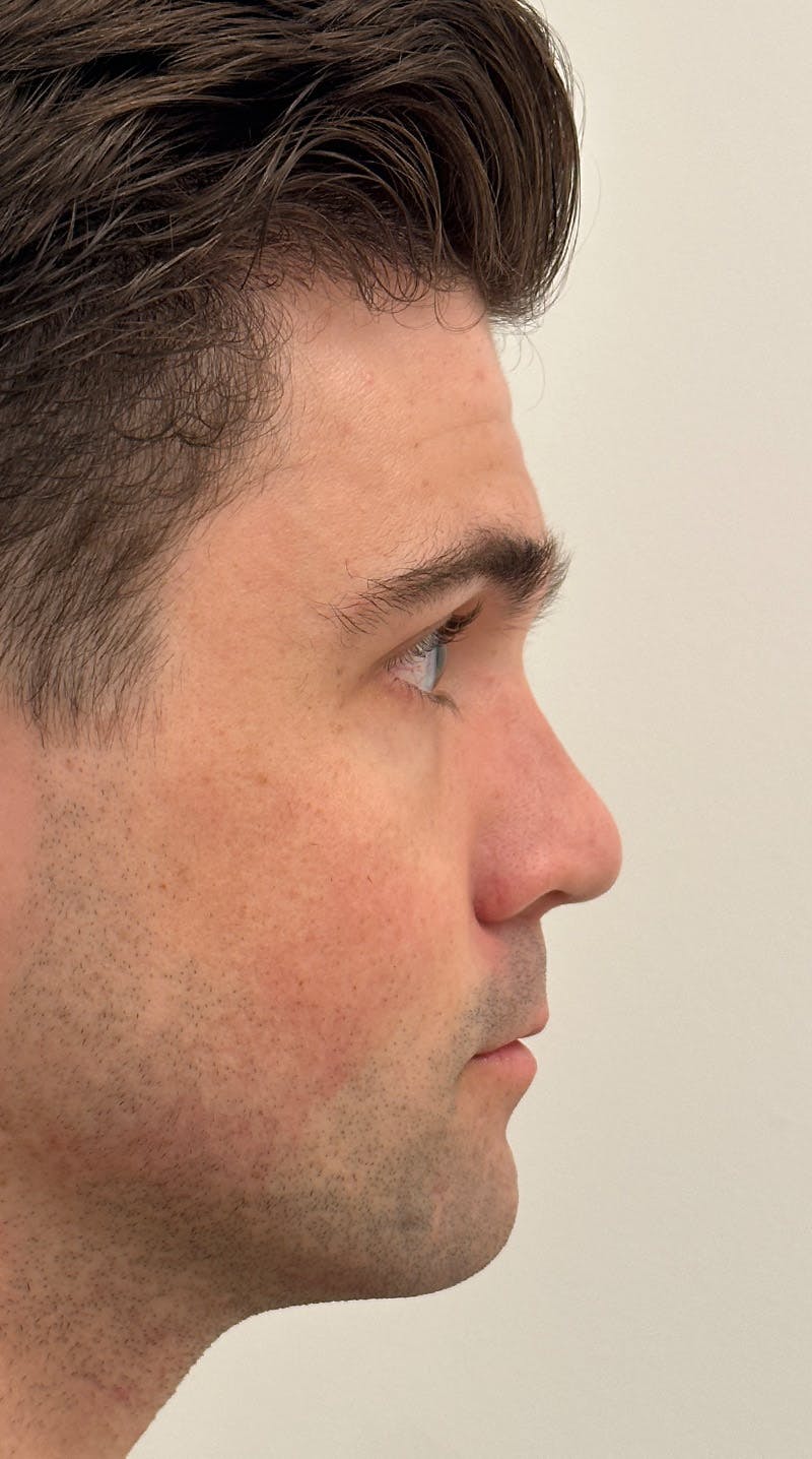 Rhinoplasty Before & After Gallery - Patient 148972634 - Image 10