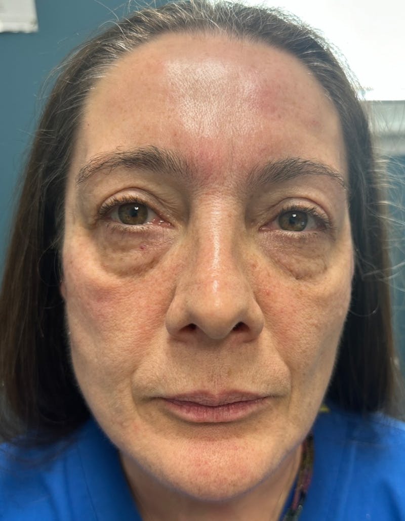 Fillers Before & After Gallery - Patient 148972640 - Image 1