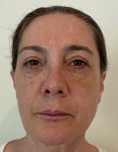 Fillers Before & After Gallery - Patient 148972640 - Image 2