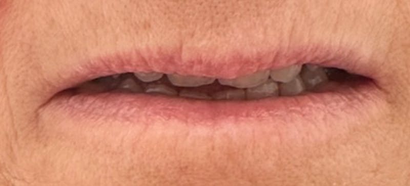Lip Augmentation Before & After Gallery - Patient 148972666 - Image 1