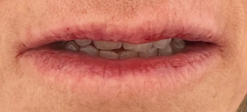 Lip Augmentation Before & After Gallery - Patient 148972666 - Image 2