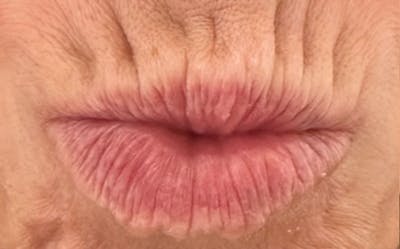 Lip Augmentation Before & After Gallery - Patient 148972665 - Image 1