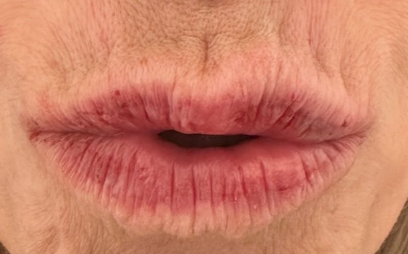 Lip Augmentation Before & After Gallery - Patient 148972665 - Image 2