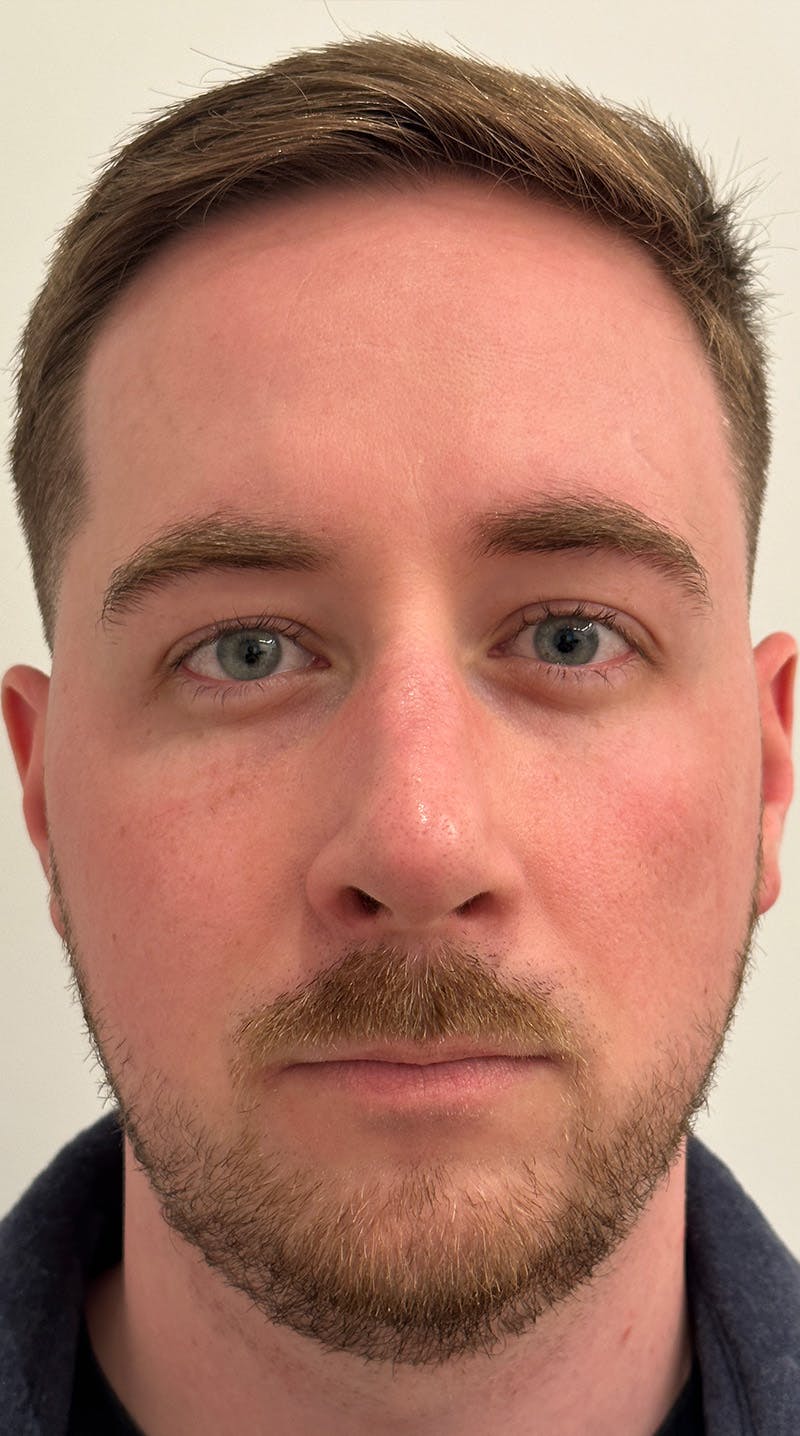 Rhinoplasty Before & After Gallery - Patient 122833307 - Image 6