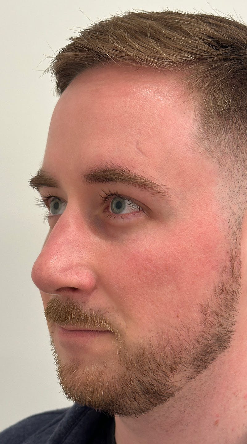 Rhinoplasty Before & After Gallery - Patient 122833307 - Image 8