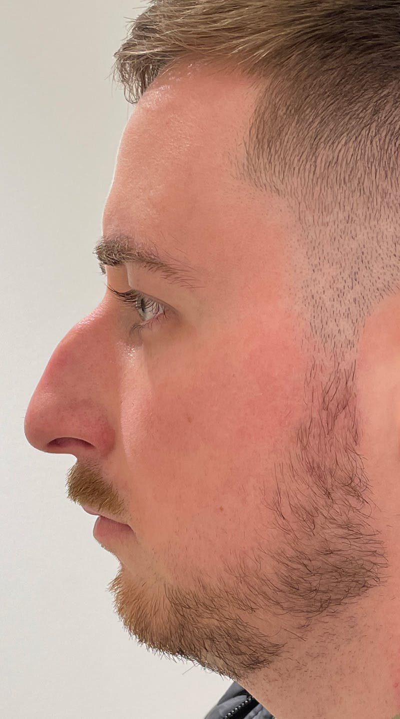 Rhinoplasty Before & After Gallery - Patient 122833307 - Image 9