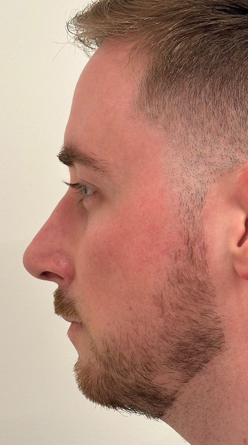 Rhinoplasty Before & After Gallery - Patient 122833307 - Image 10