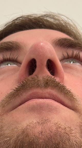 Rhinoplasty Before & After Gallery - Patient 122833307 - Image 12