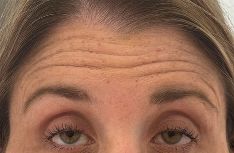 BOTOX Before & After Gallery - Patient 157556644 - Image 1