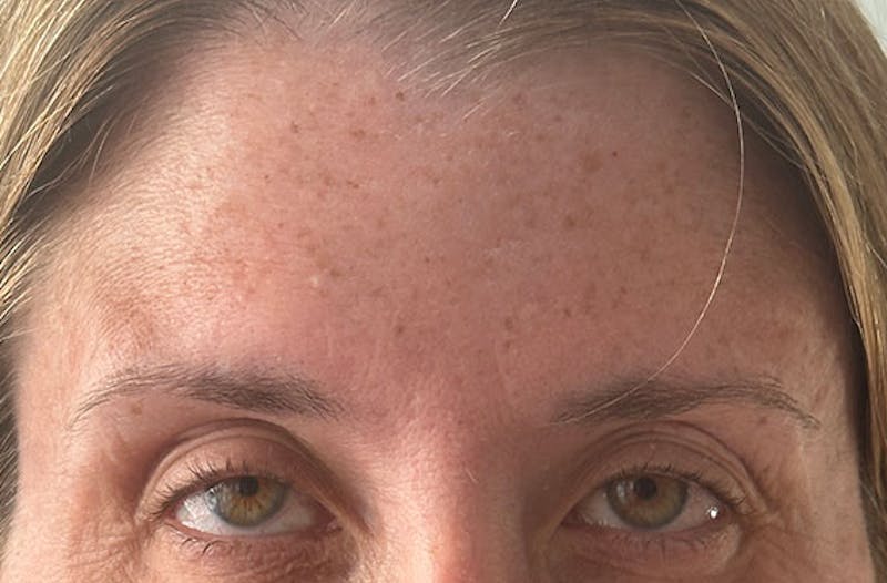 BOTOX Before & After Gallery - Patient 157556644 - Image 2