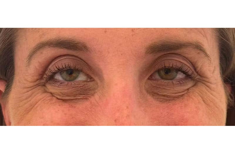 BOTOX Before & After Gallery - Patient 157556644 - Image 3