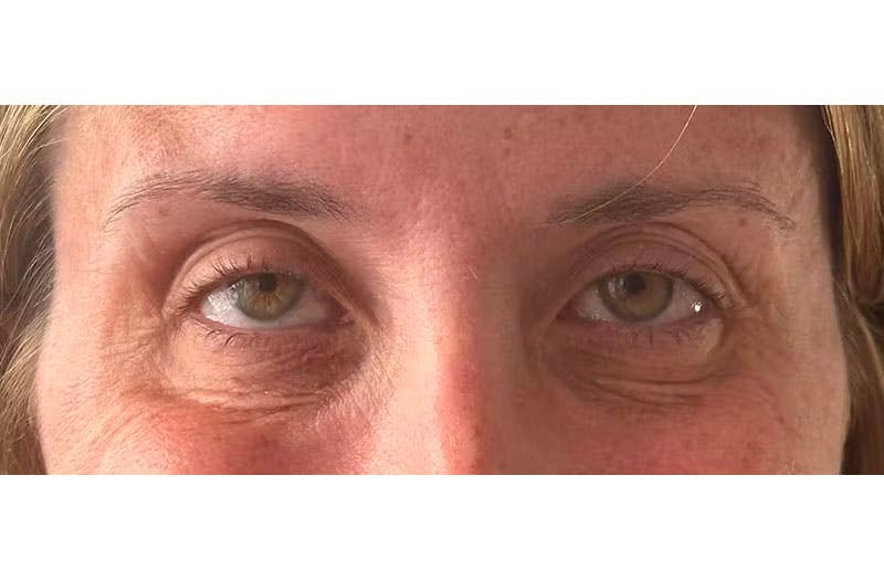 BOTOX Before & After Gallery - Patient 157556644 - Image 4
