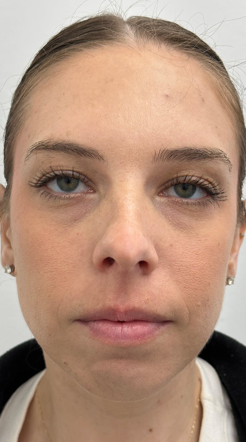 Rhinoplasty Before & After Gallery - Patient 386384 - Image 1