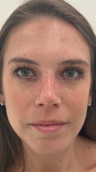 Rhinoplasty Before & After Gallery - Patient 386384 - Image 2