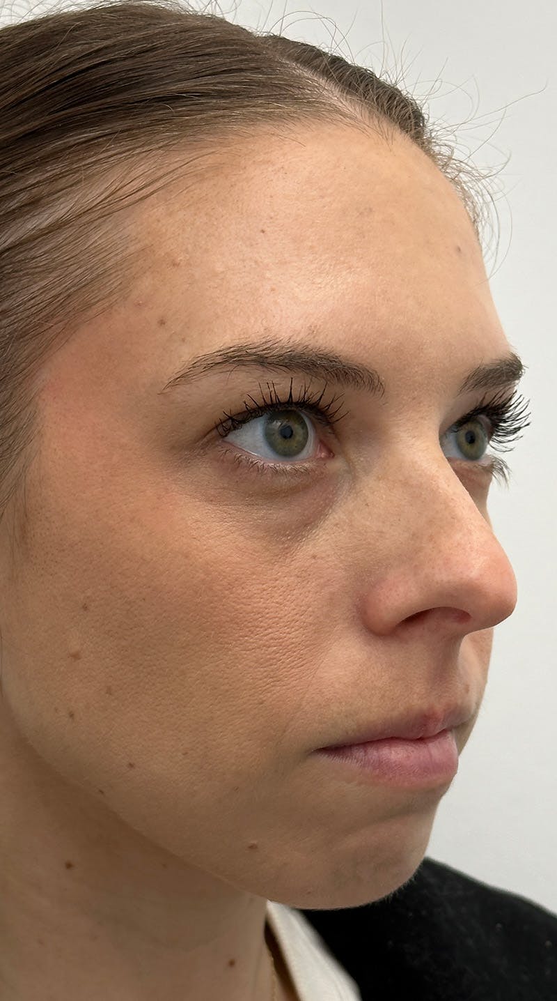Rhinoplasty Before & After Gallery - Patient 386384 - Image 3