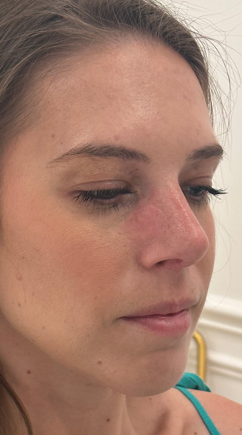 Rhinoplasty Before & After Gallery - Patient 386384 - Image 4